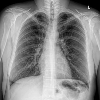 Знімок флюорографії легень